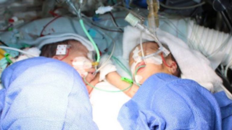 خضعت الطفلتان لعملية جراحية لفصل التصاقهما في ديسمبر/كانون الأول